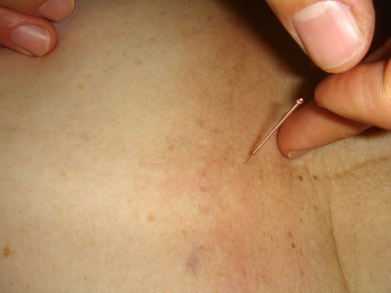 acupuncture2