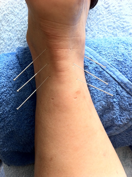 acupuncture-1211182_960_720