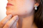 Acne Skin Care Tips For Better Skin