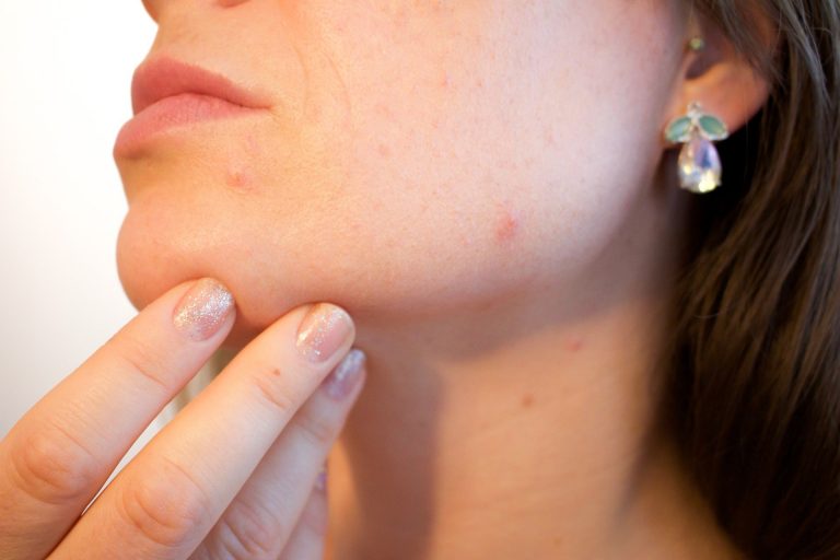 acne-1606765_1920 (1)