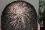 Tips On Finding The Best Hair Loss Treatment