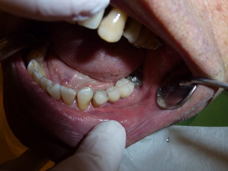 implant-1527310_1920