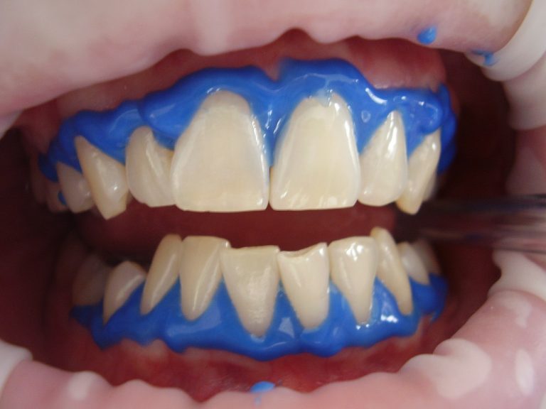 laser-teeth-whitening-716468_1280