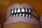 What You Need To Know About Partial Dentures