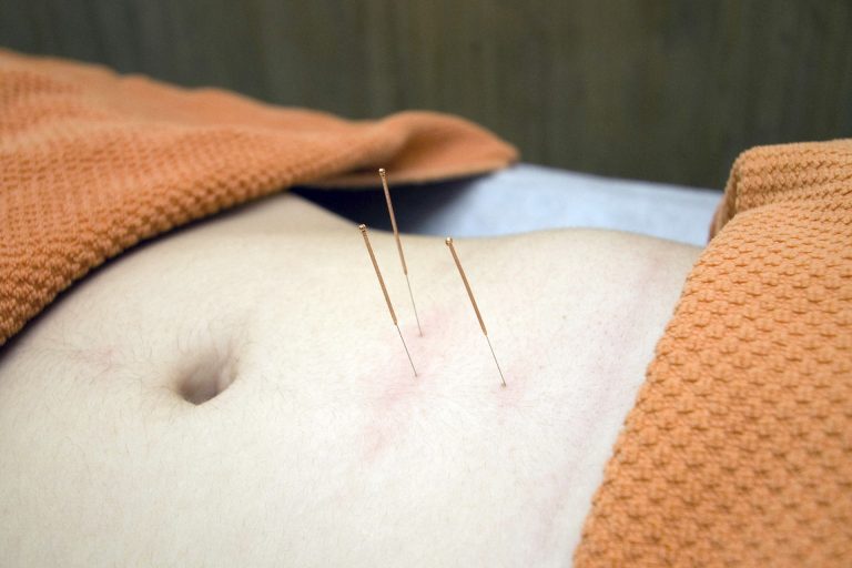 acupuncture-4175624_1920