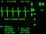 Sinus Tachycardia ECG: What You Need To Know